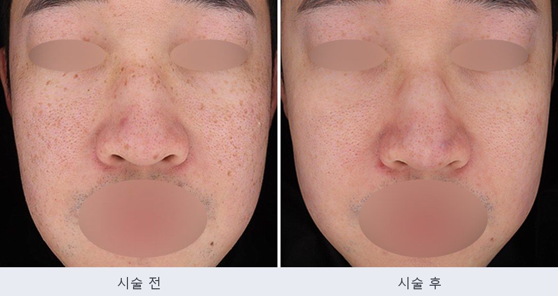 기미 주근깨 붉은자국
