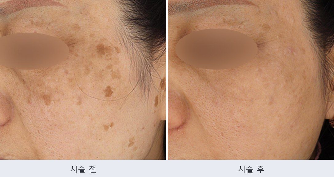 흑자 기미